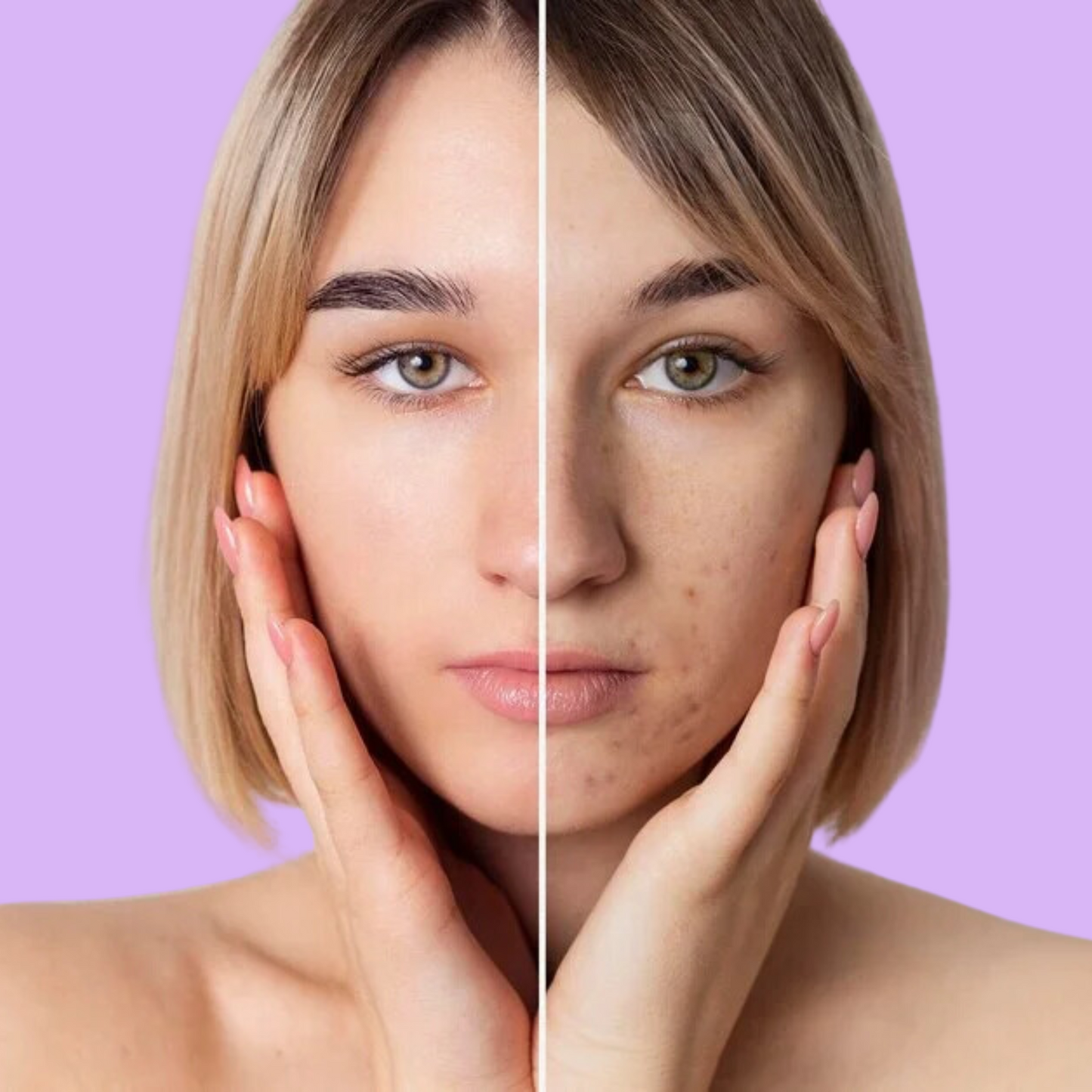 Acne Hydra Facial - 45min