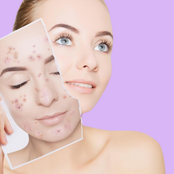 IPL Acne Treatments - Please Select the Specific Service