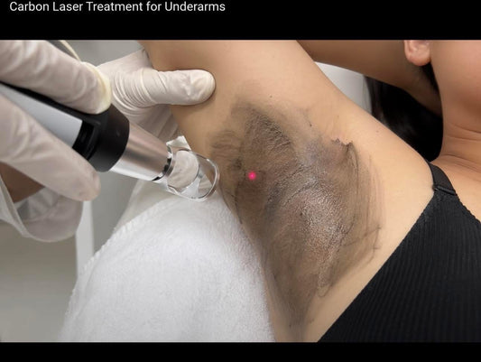 Carbon Laser
